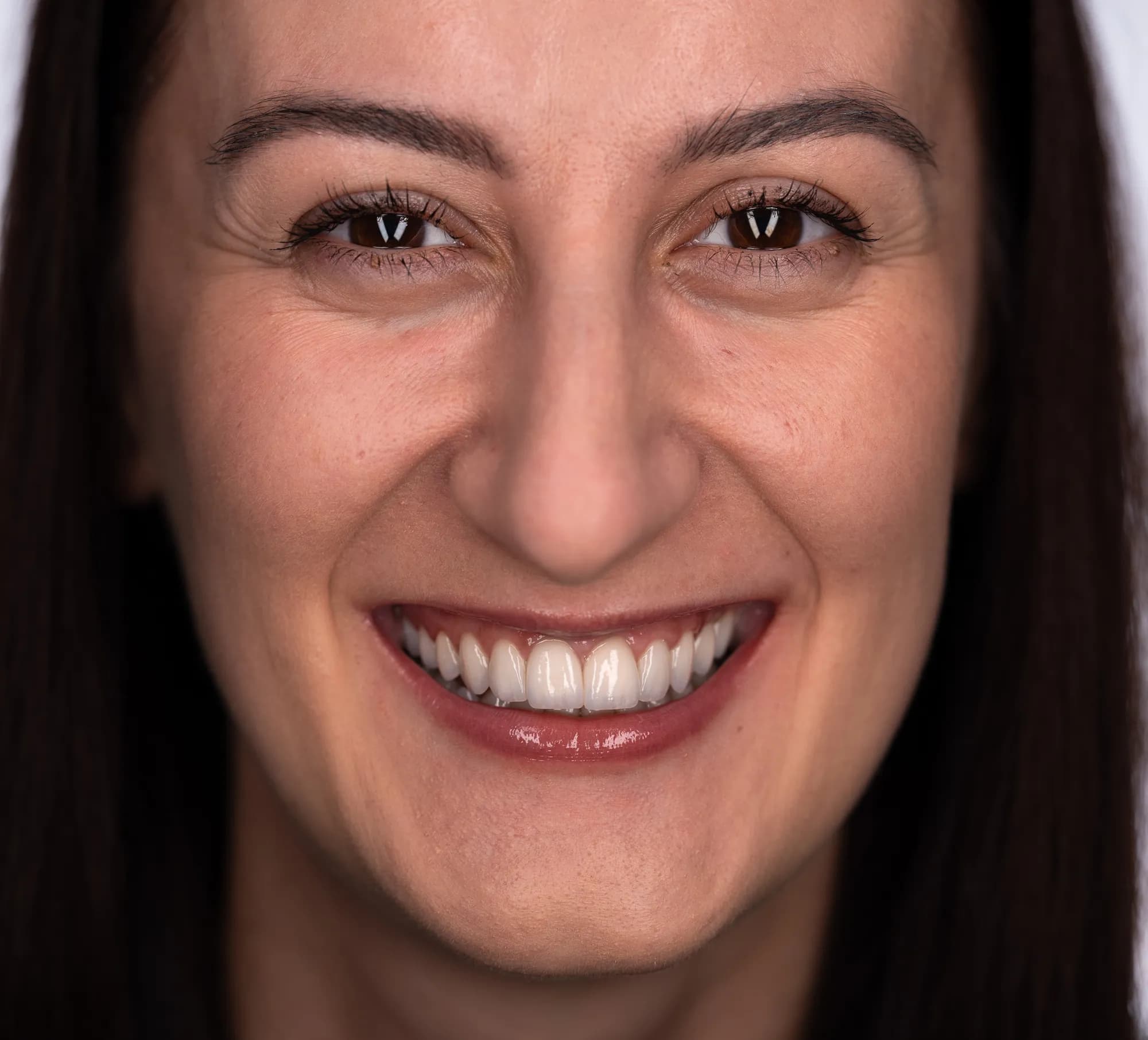 Skeletal orthodontics, implants and minimal veneers