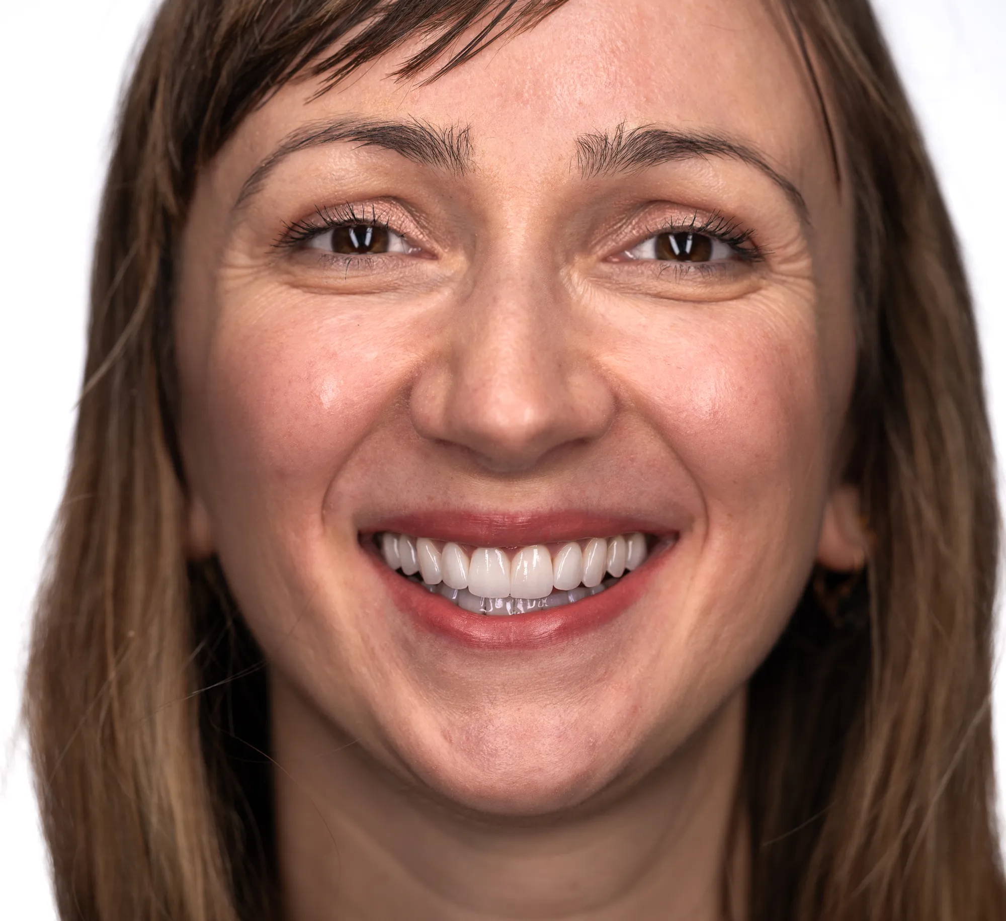 Full-arch restorations with bite correction