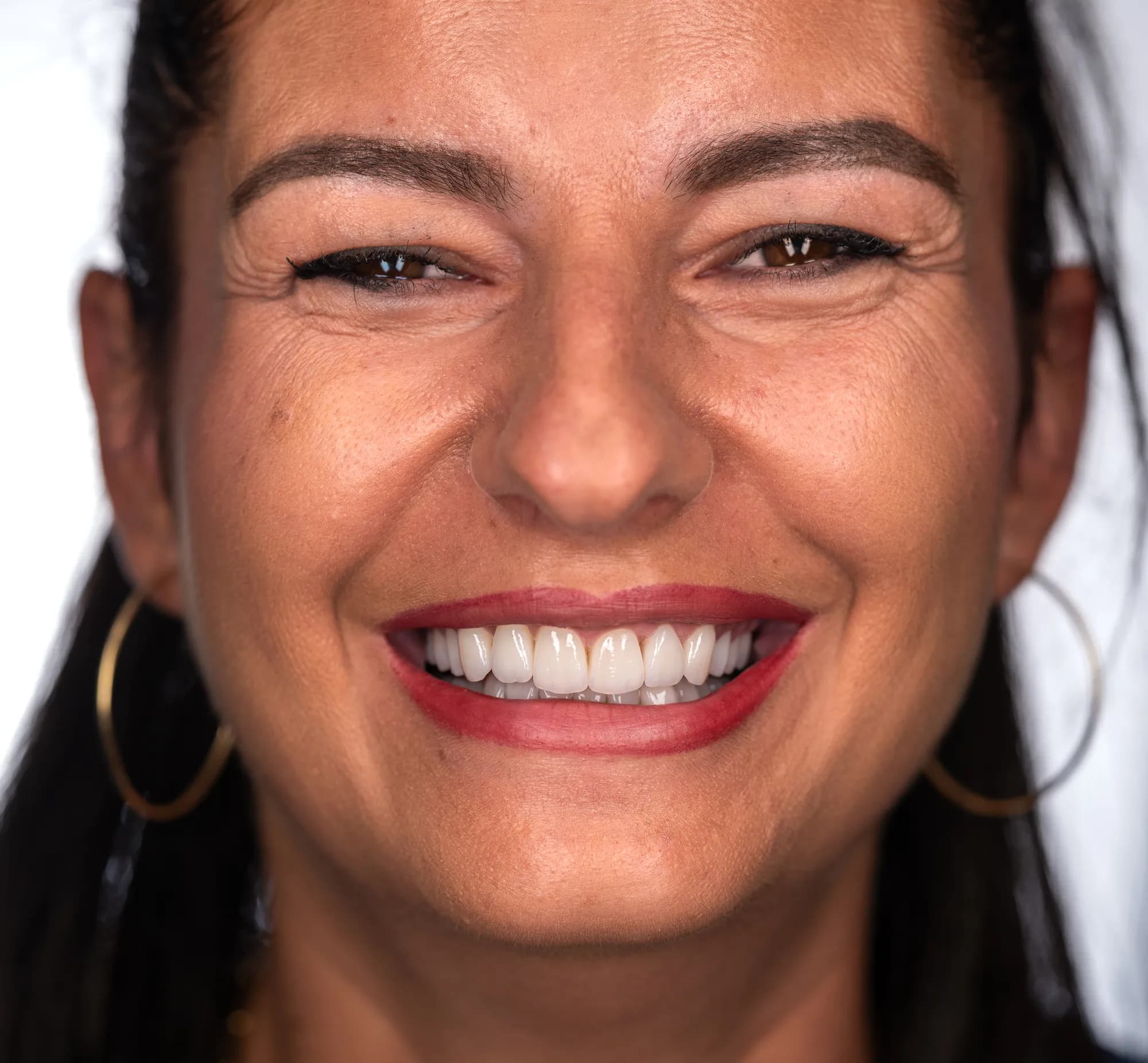 Restoring a worn smile while keeping its identity