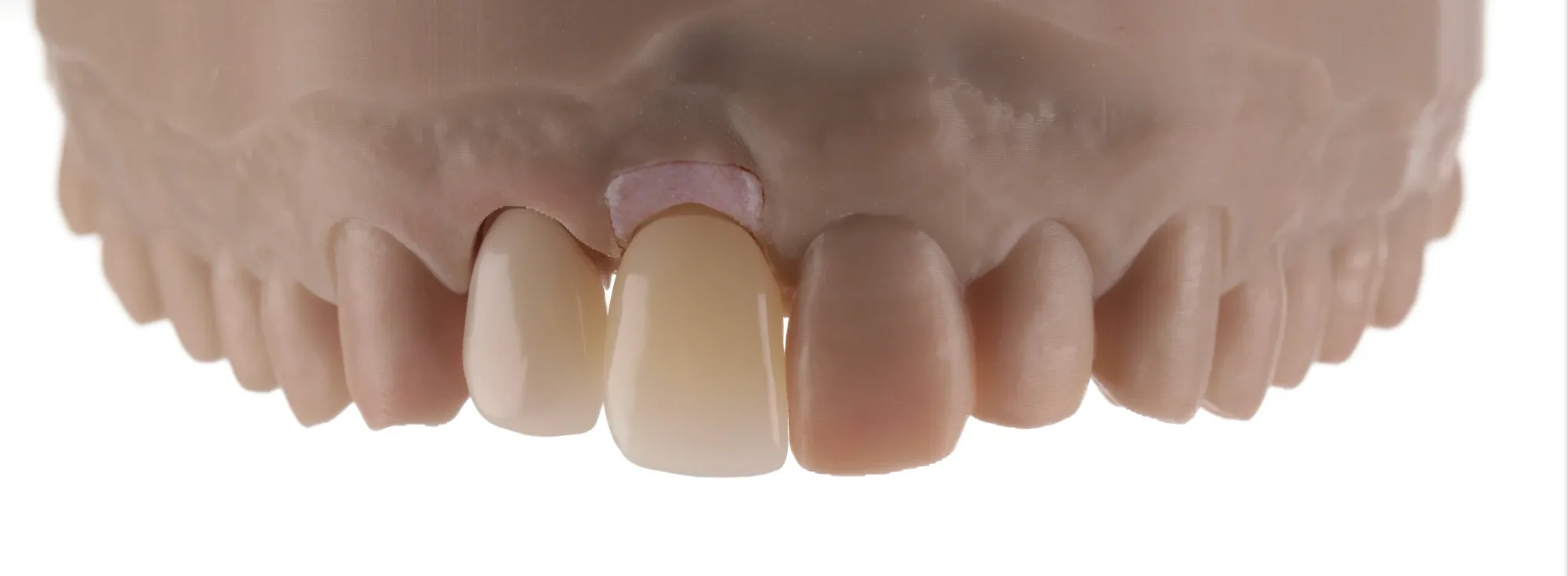 The lab-made teeth on a printed model of the patient's mouth