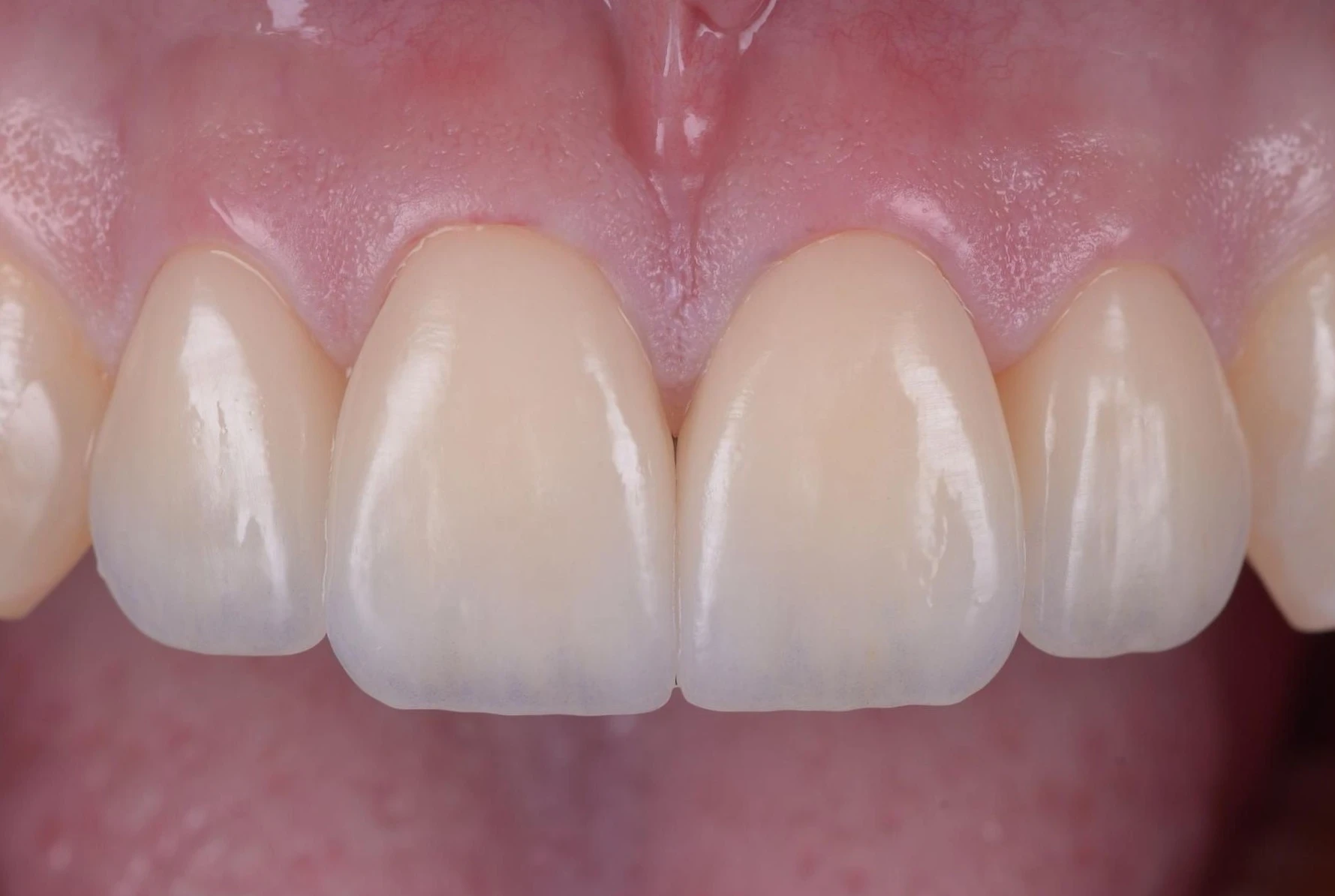 The veneers right after the rubber dam was removed