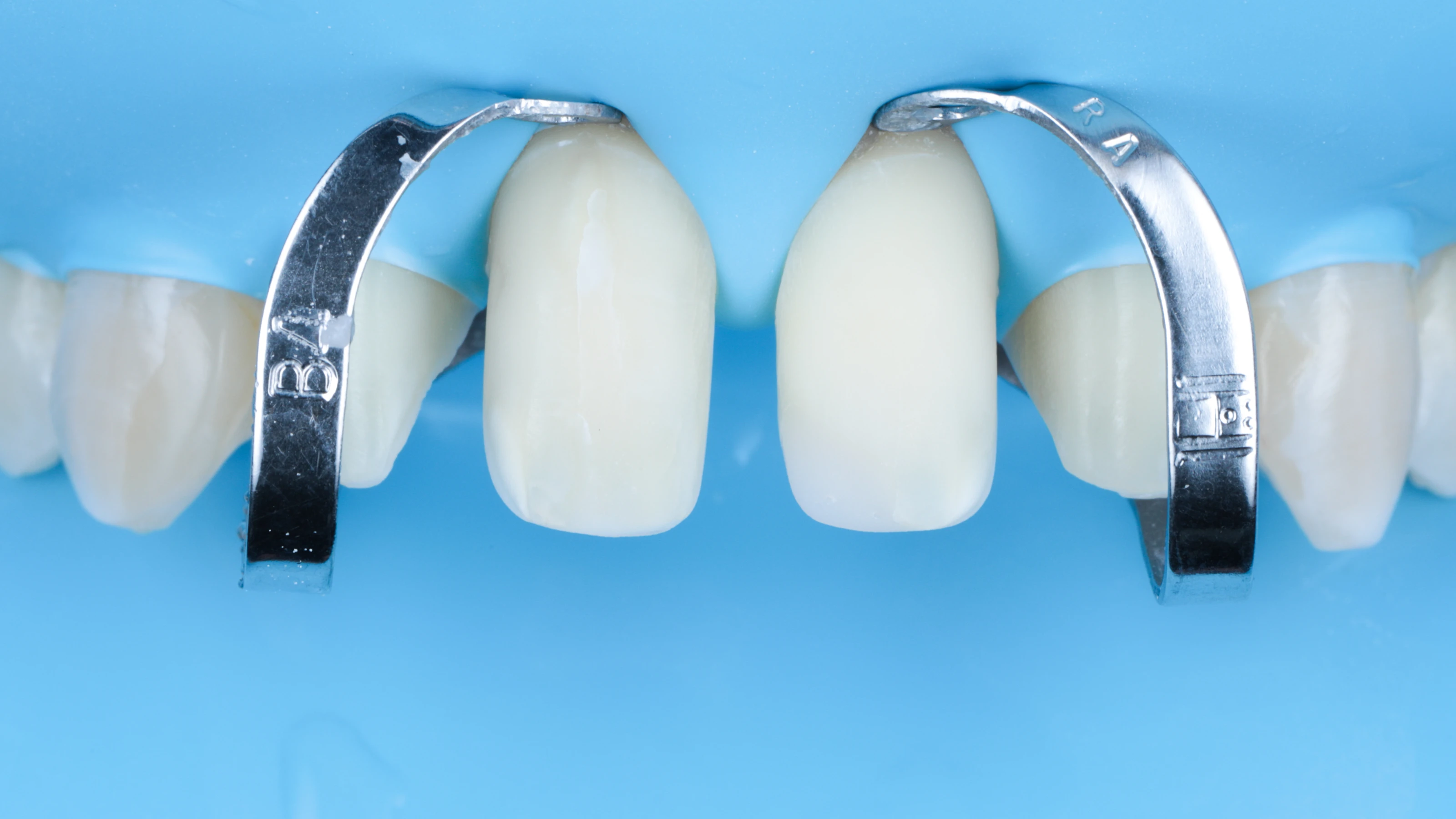 The teeth isolated from saliva with a rubber dam