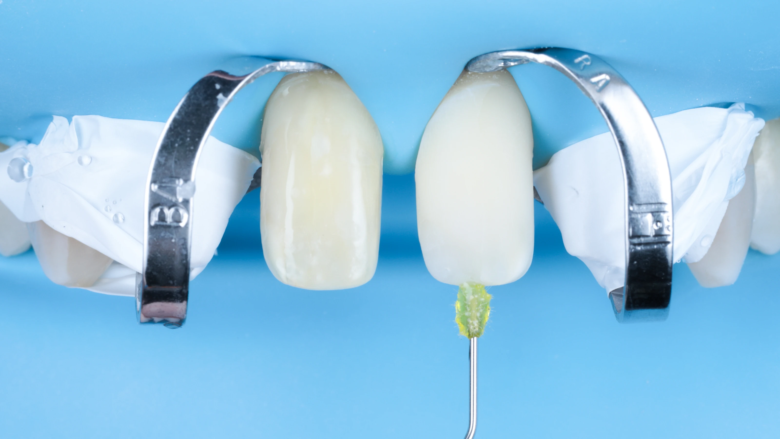 A bonding agent applied to the tooth