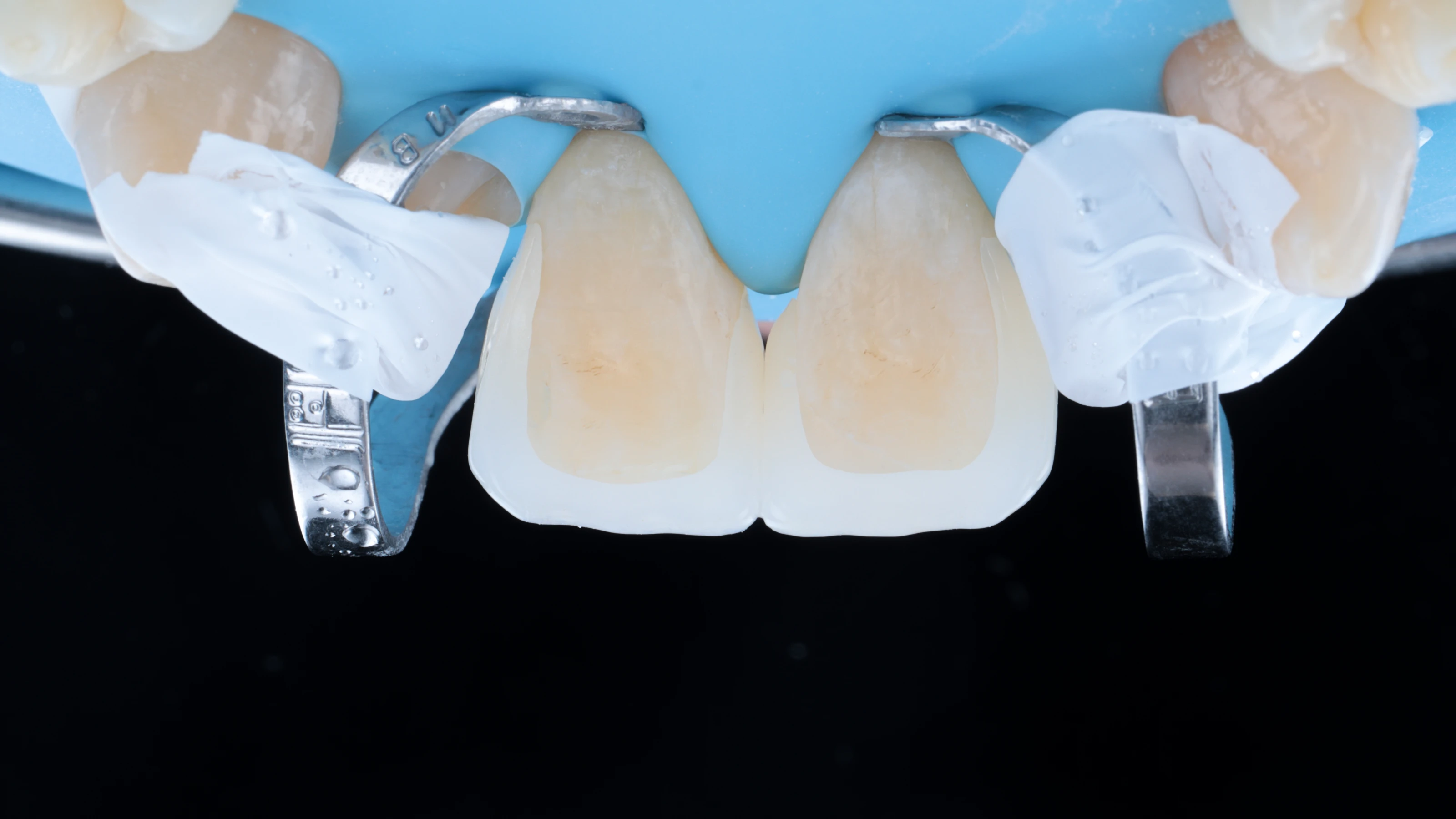 The veneers seated on the teeth