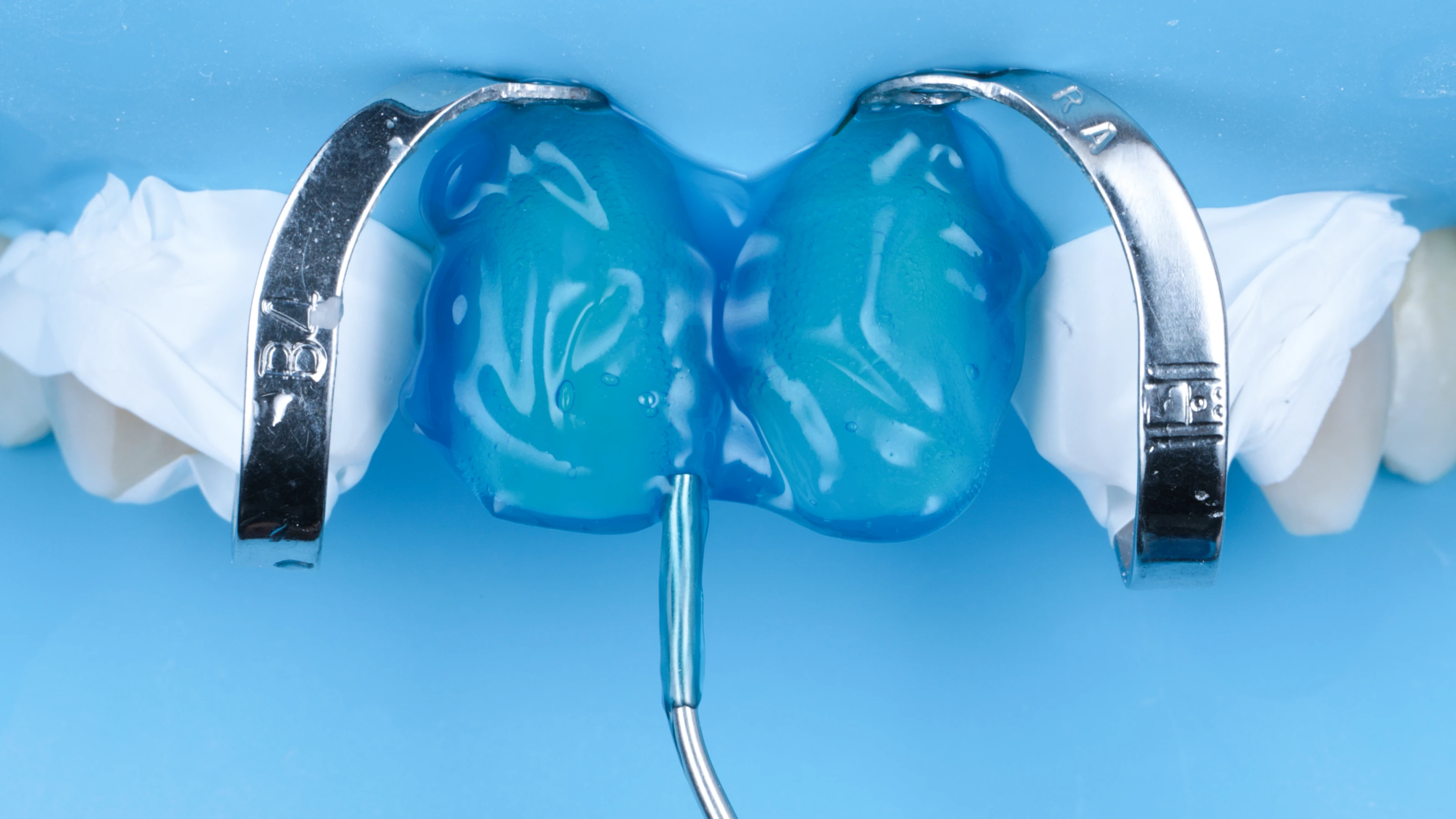 The tooth surface conditioned with an etching gel