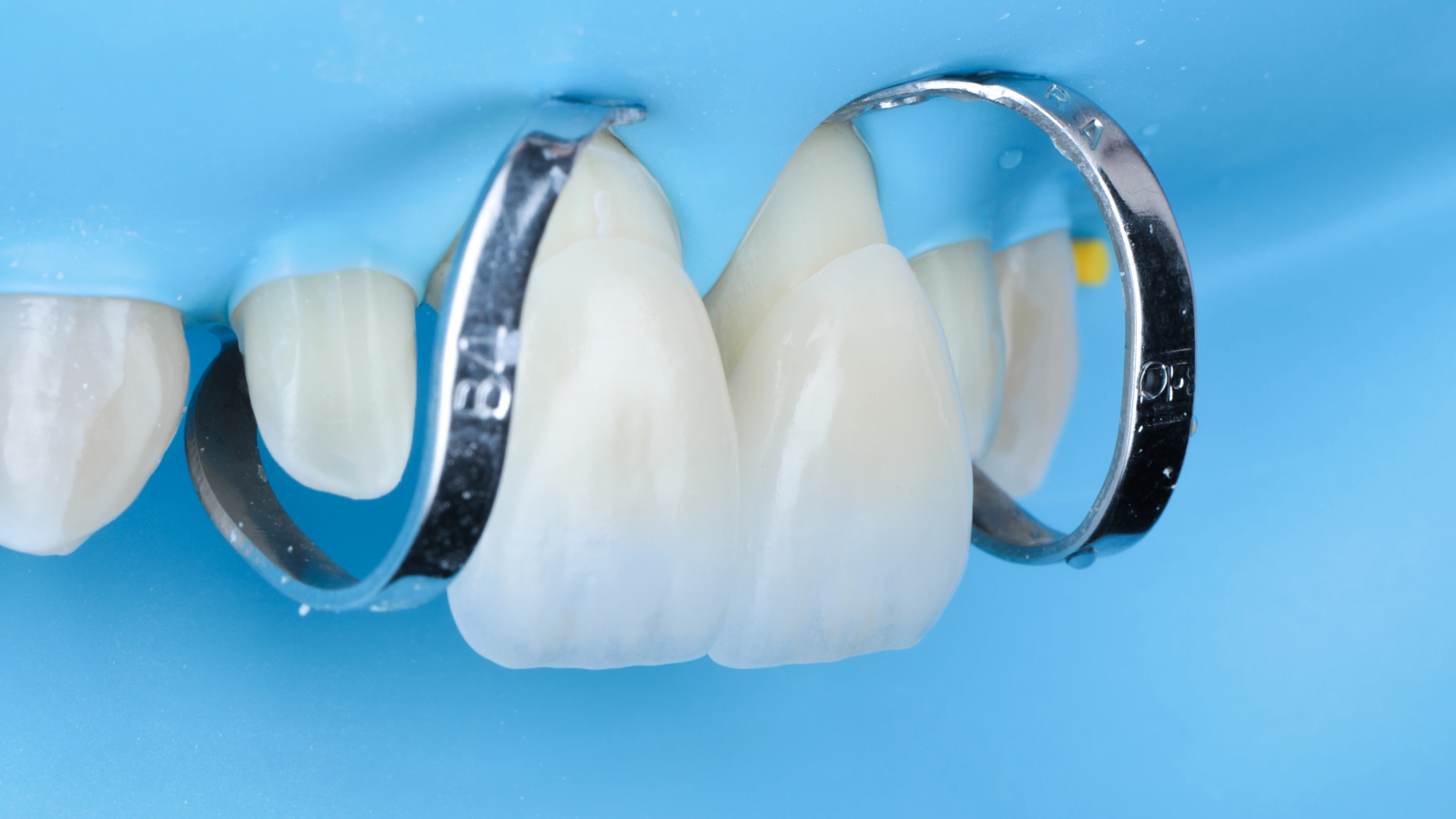 The veneers tried in, seen from the side