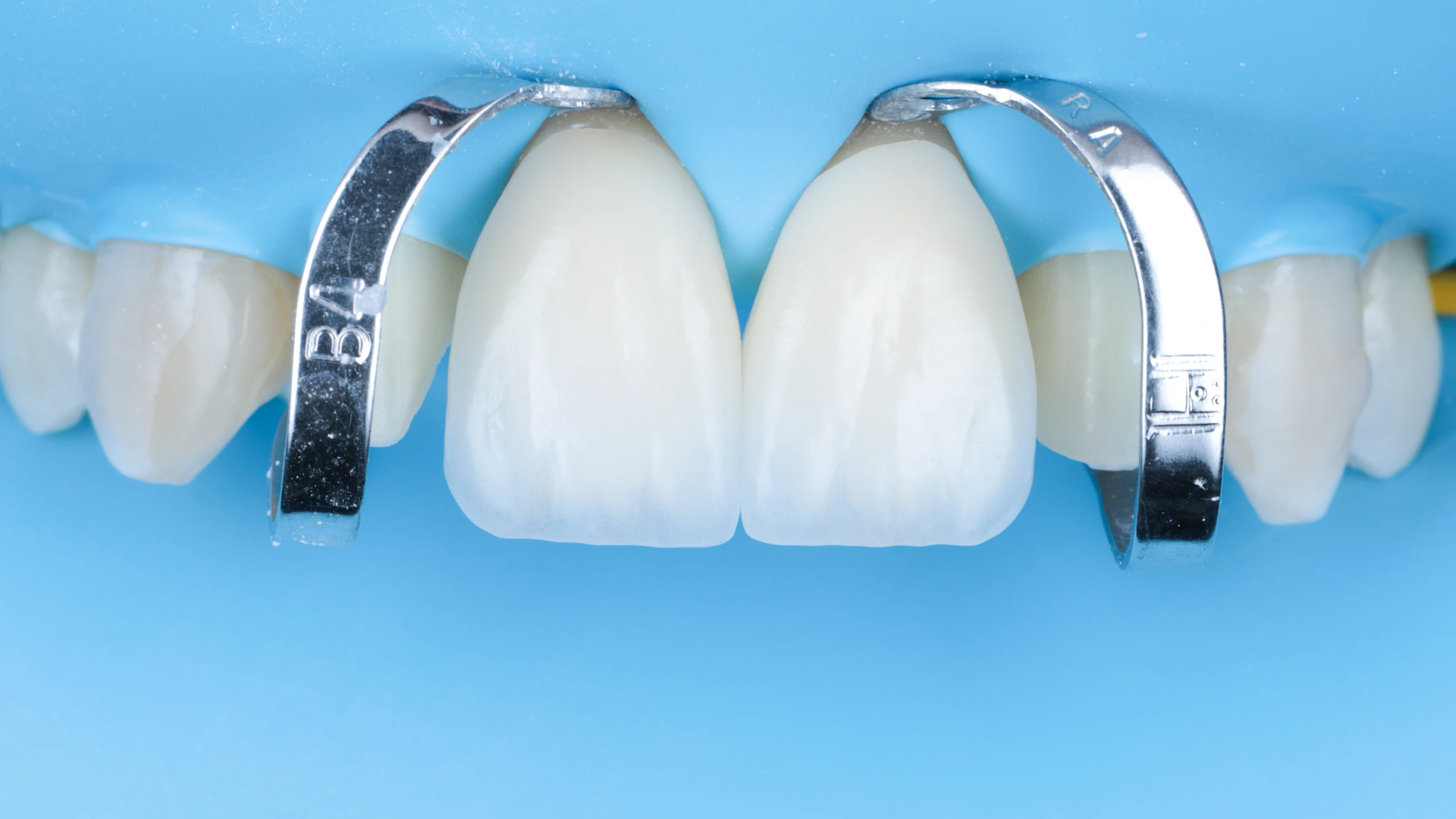 The ceramic tried in before bonding