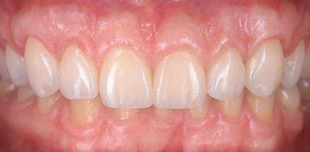 esthethic-gum-treatment