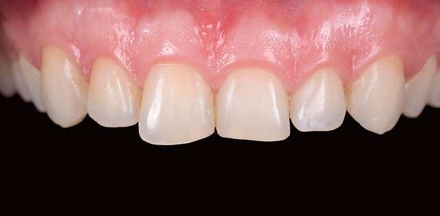 gingival-conouring