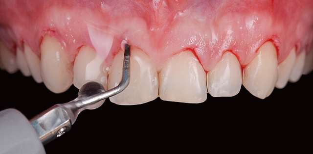 periodontal-procedure