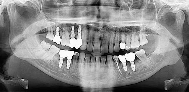 implant-xray