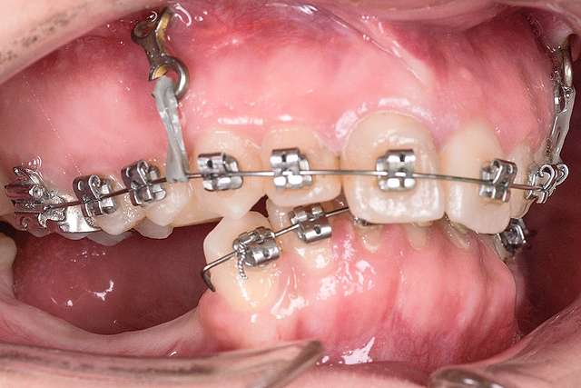 adult-dental-braces