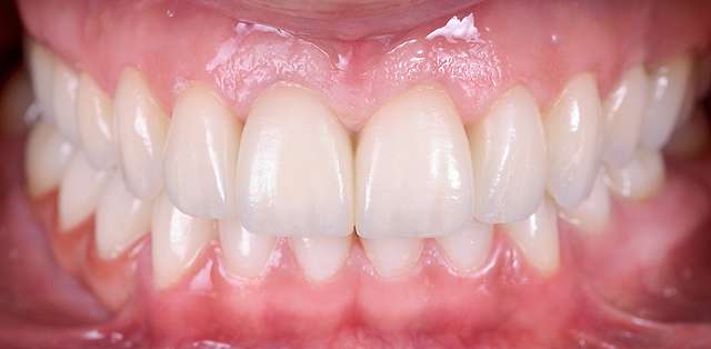 dental-braces-results