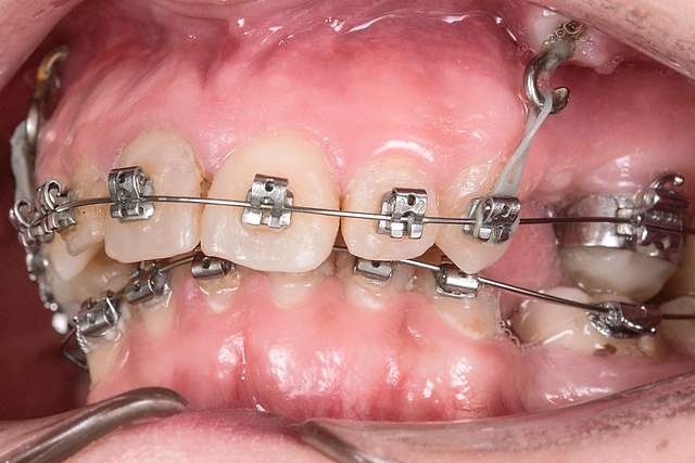 dental-brackets