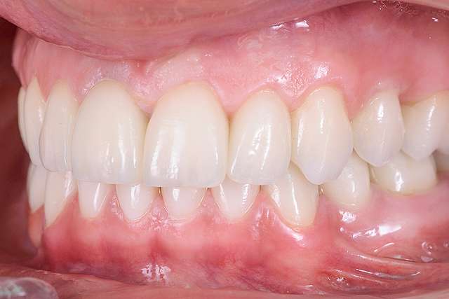 orthodontic-progress