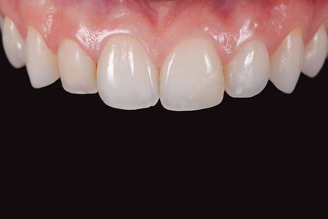 before-veneers