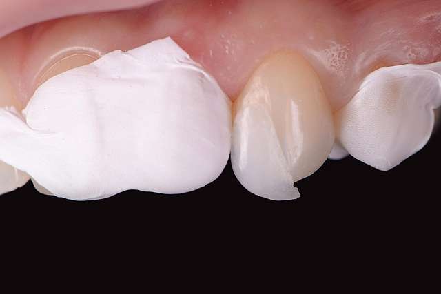 no-enamel-removal