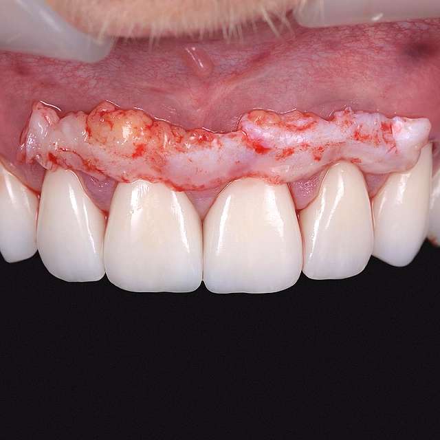 gingival-health