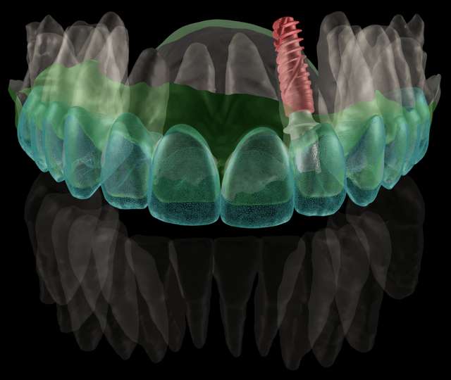 implant-position