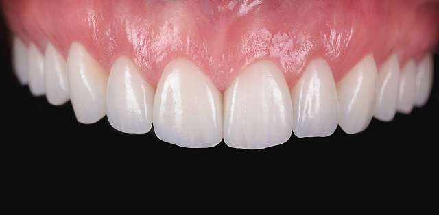 dental-veneers