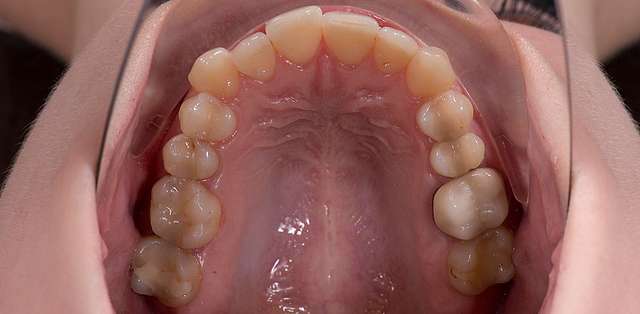 teeth-3
