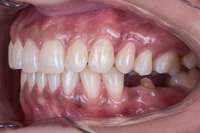 teeth-1-r