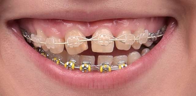 teeth-03