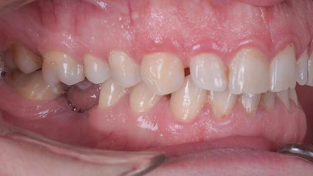teeth-1-l