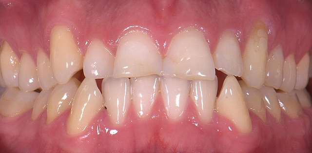 teeth-1
