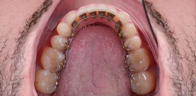 teeth-5
