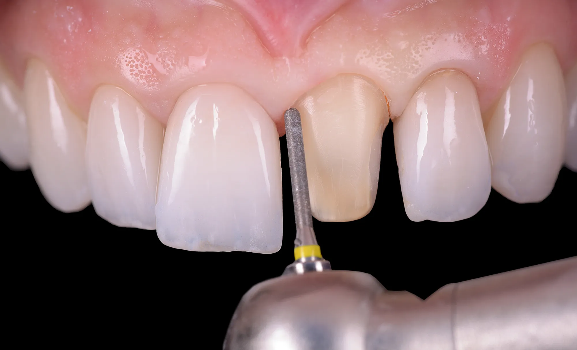 A front tooth being prepared along the design