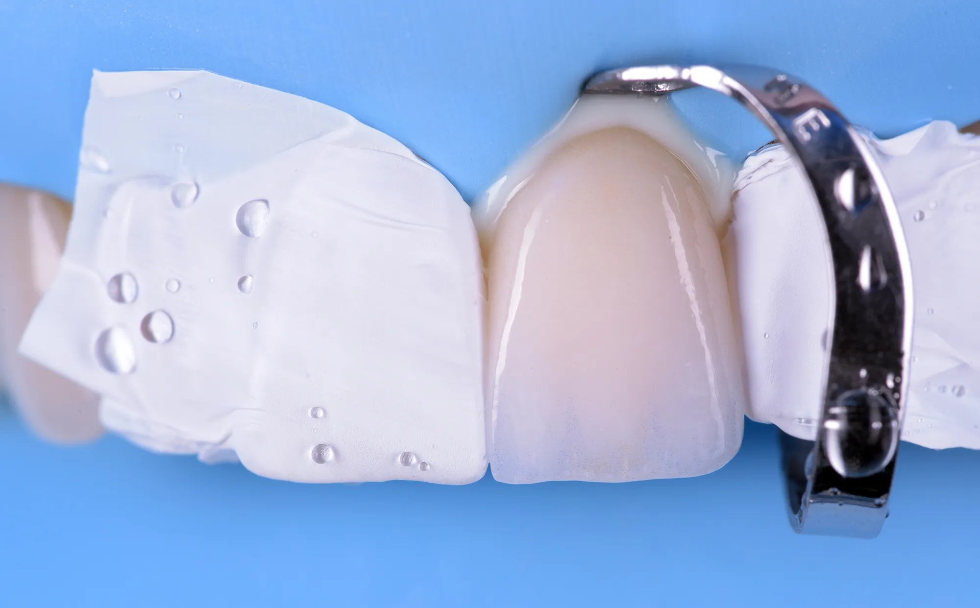 A ceramic crown checked on the model in the lab