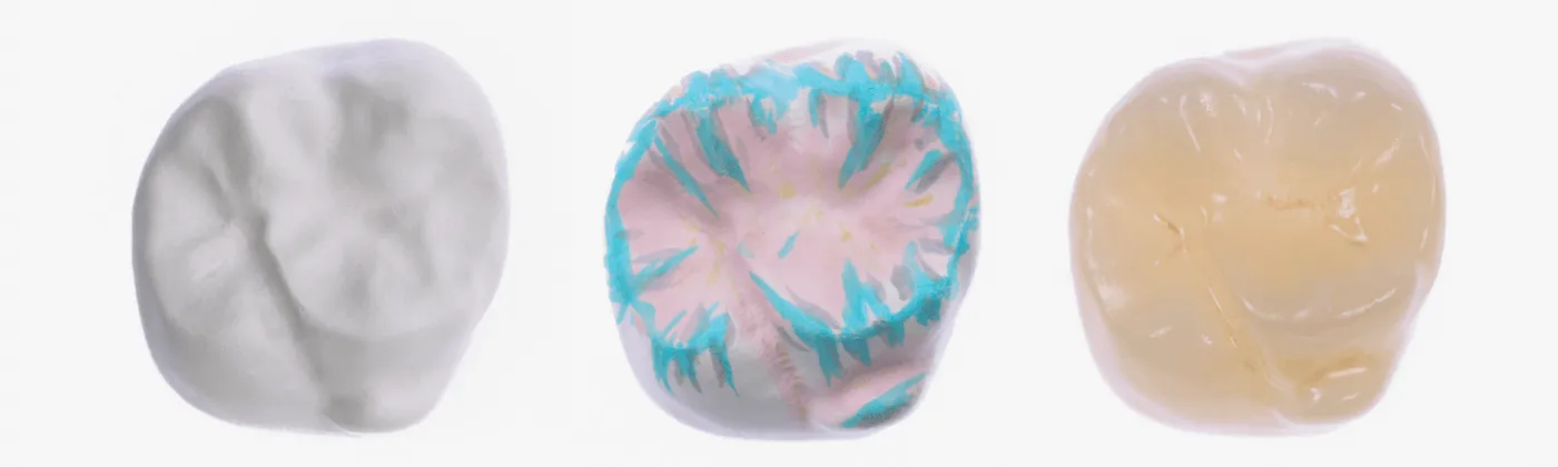 A molar crown: digital design, milled shape and finished zirconia