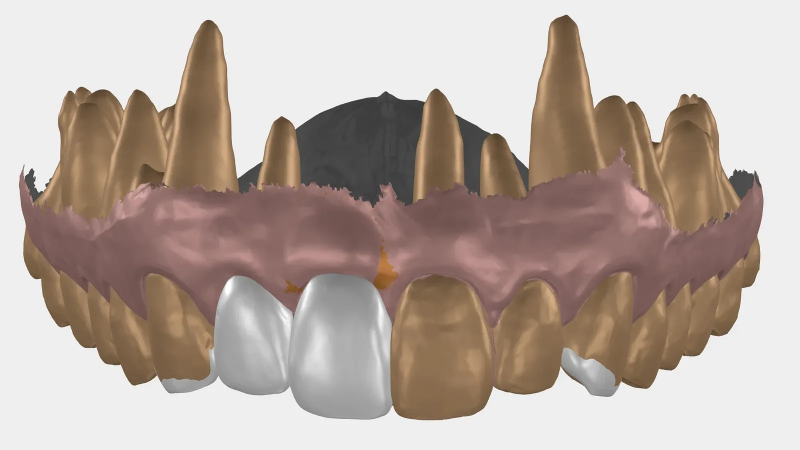 The 3D design of the new front teeth on the scan of the patient's own teeth