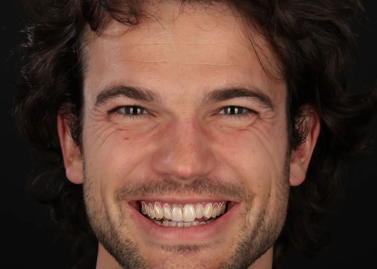 A patient's current smile with the planned tooth outlines