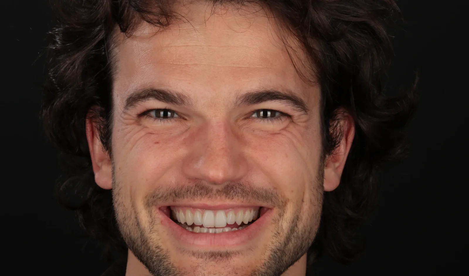 The same patient with the designed smile, simulated before treatment