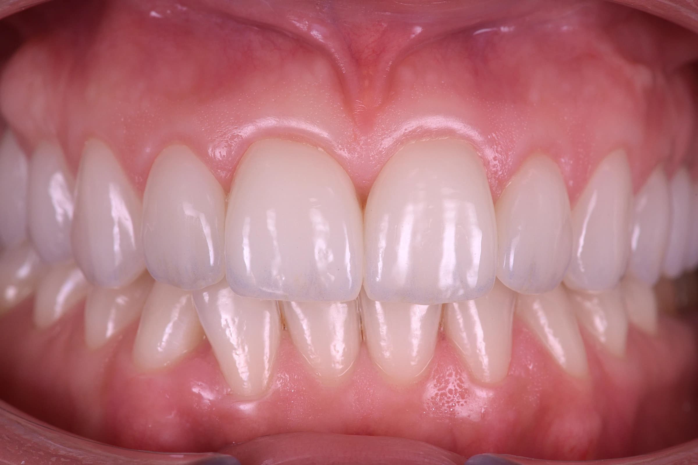 The veneers after bonding