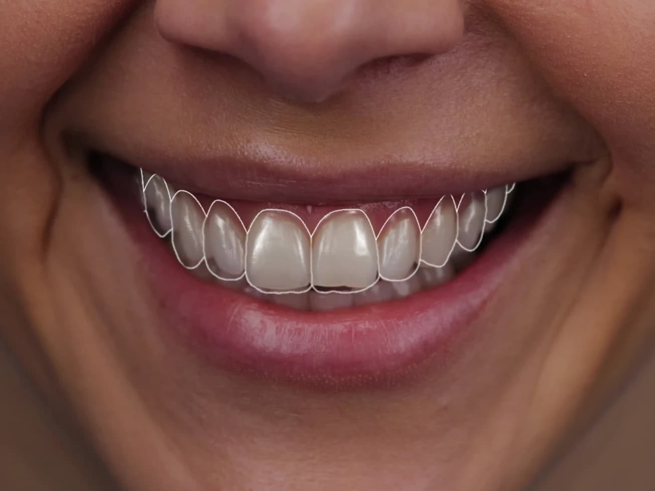 The planned teeth outlined on the patient's smile