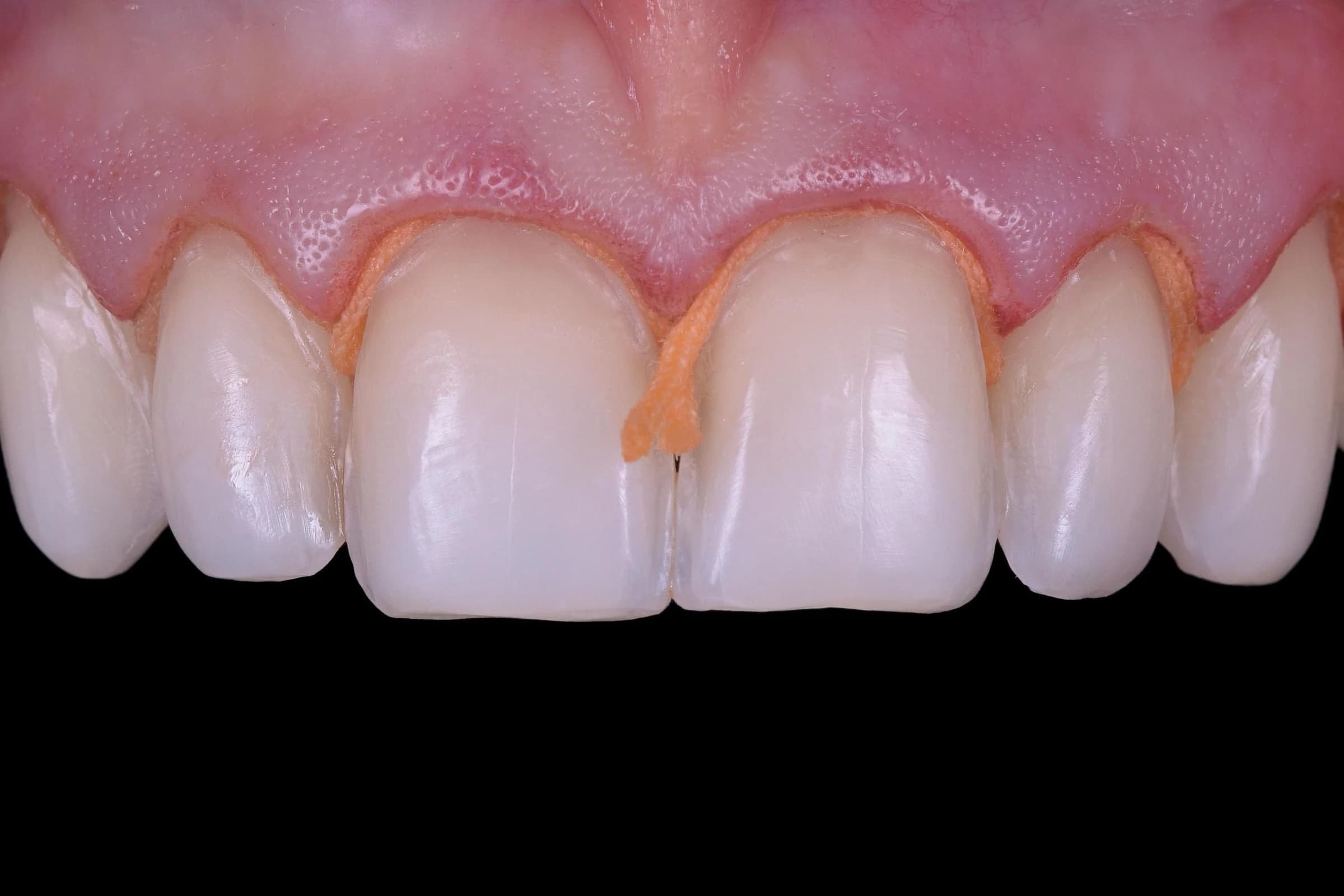 The teeth after minimal preparation, guided by the design