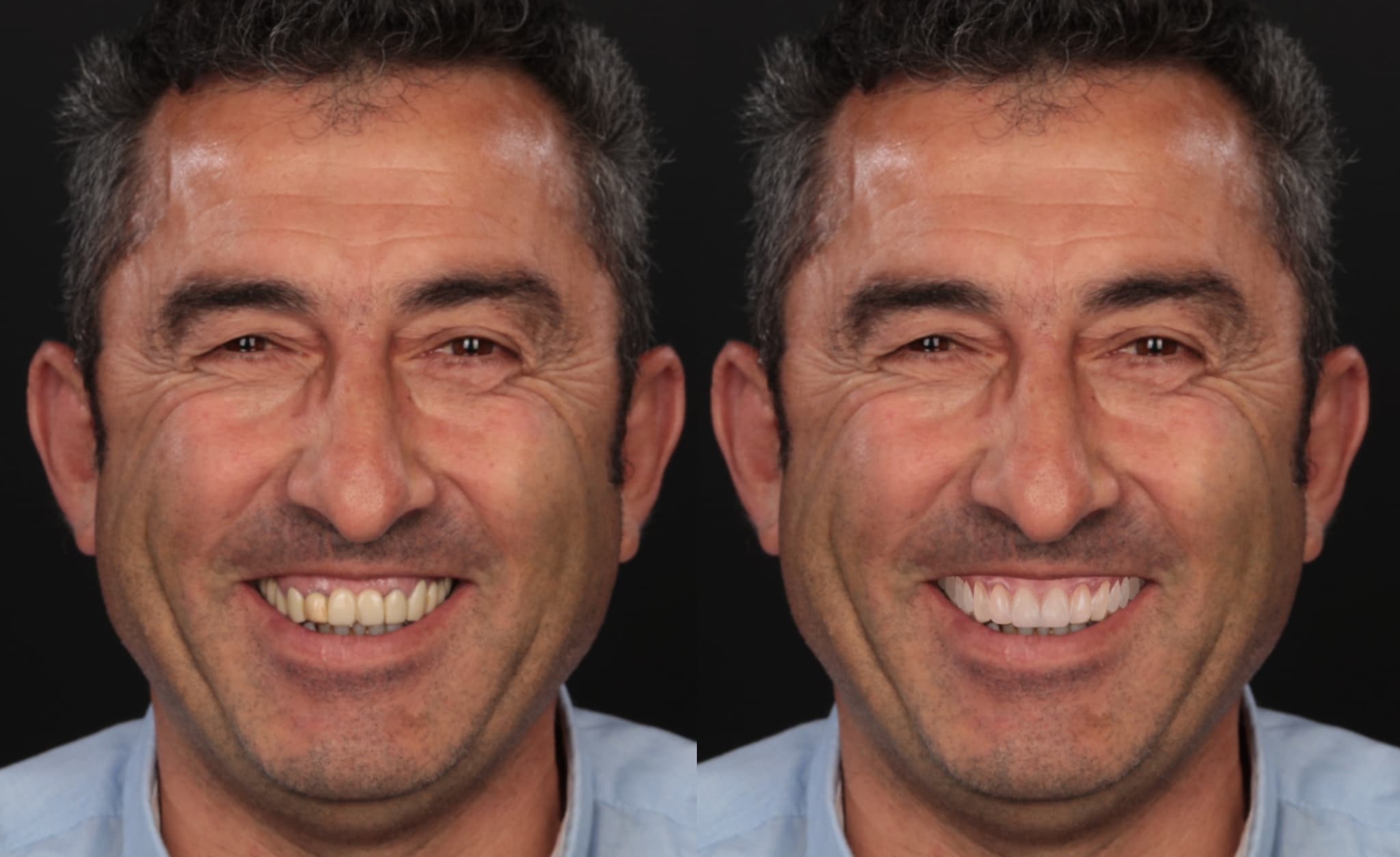 B&A all on X-1