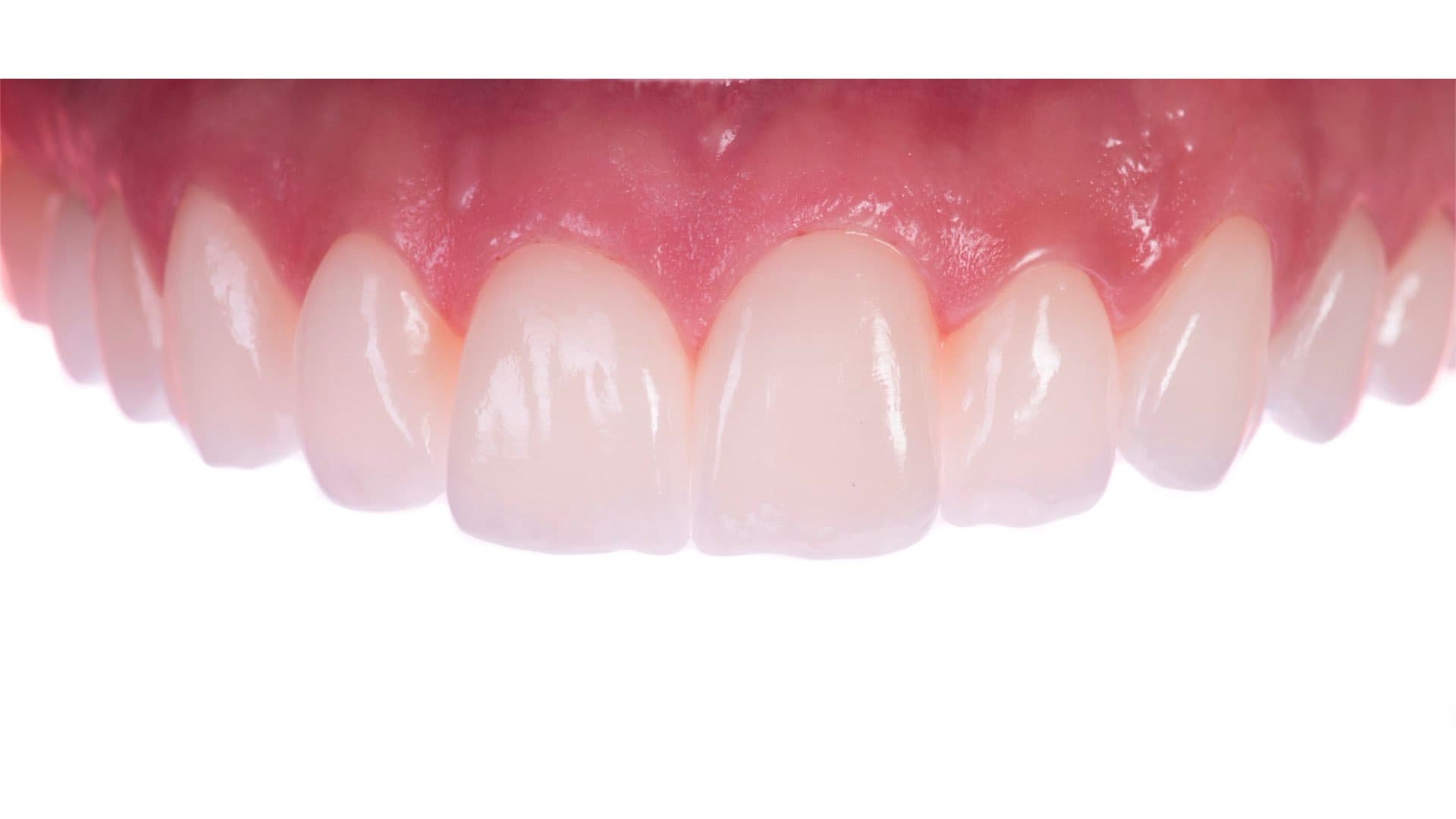 dental crowns