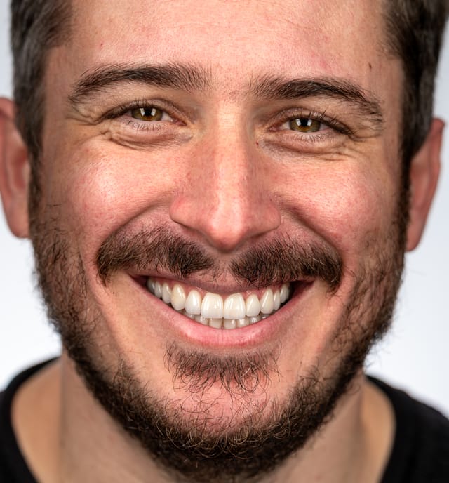 Frontal view showing corrected vertical dimension, restored edentulous spaces, and harmonious anterior display.