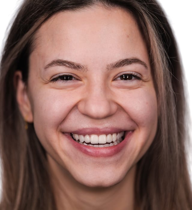 Vedere frontală după tratamentul interdisciplinar