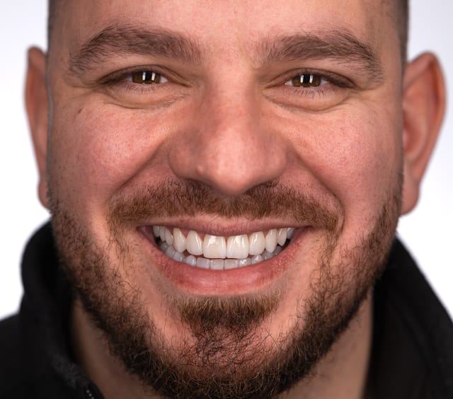 Implant crown and veneers follow natural transitions in texture and value. Shape respects original identity.