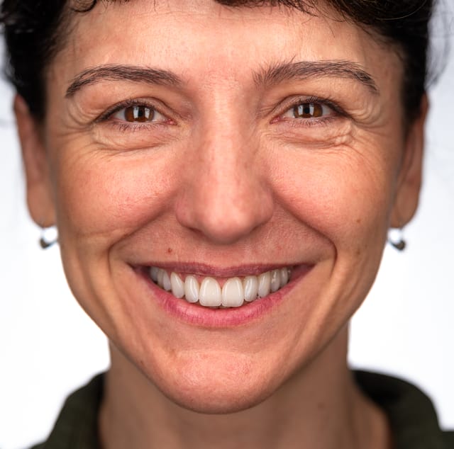 Frontal image showing regenerated papillae and restored gingival harmony after tissue-focused interdisciplinary treatment.