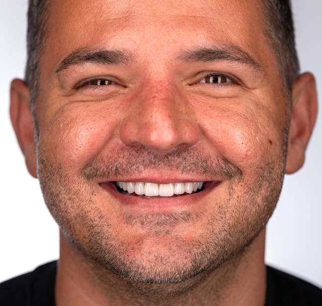 Full-arch veneer restorations after vertical dimension increase. Functional and aesthetic balance restored without exaggeration.