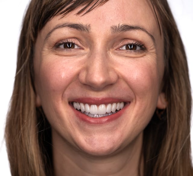 Final portrait shows full smile and display enhancement with balanced lower facial height.