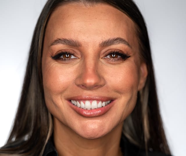 Frontal view after retreatment