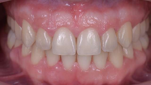 orthodontic-aligners